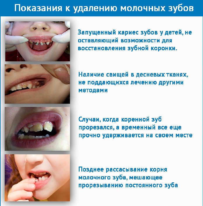 Показания к удалению молочных зубов фото