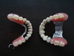 бюгельные зубные протезы фото