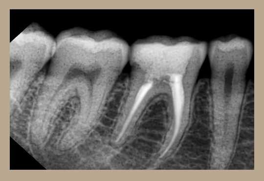 Рентген зубов фото