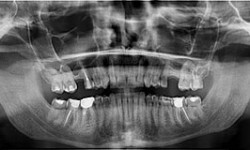 Панорамный снимок зубов фото